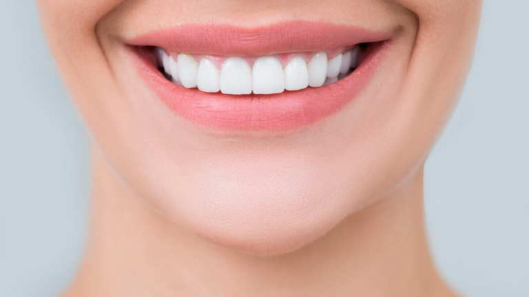 Diferença entre lente de contato dental e faceta