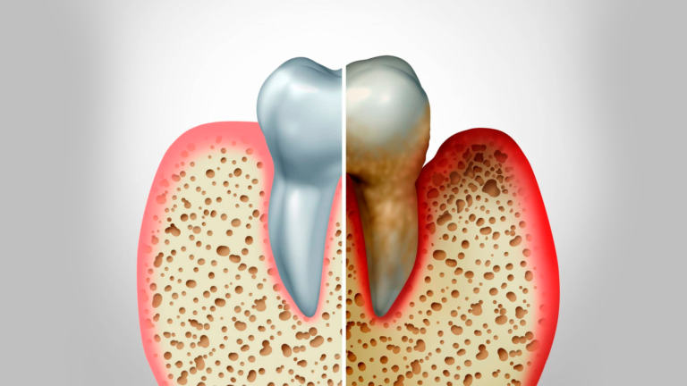 Periodontite tem tratamento?