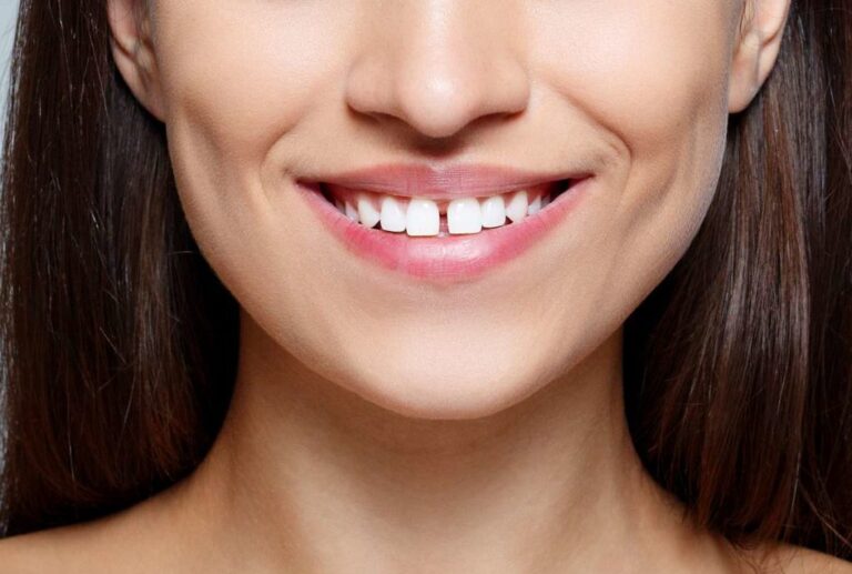 O que é diastema e como resolver essa característica?