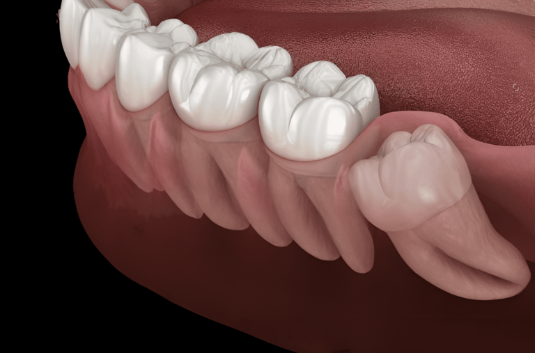 Dentes do siso: Quais problemas eles podem causar?